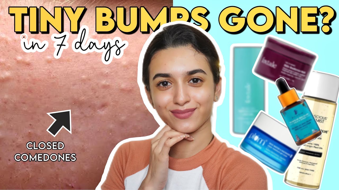I Did This for 1 Week & My Closed Comedones Disappeared!✨Skincare That Works #ClosedComedones #bumps