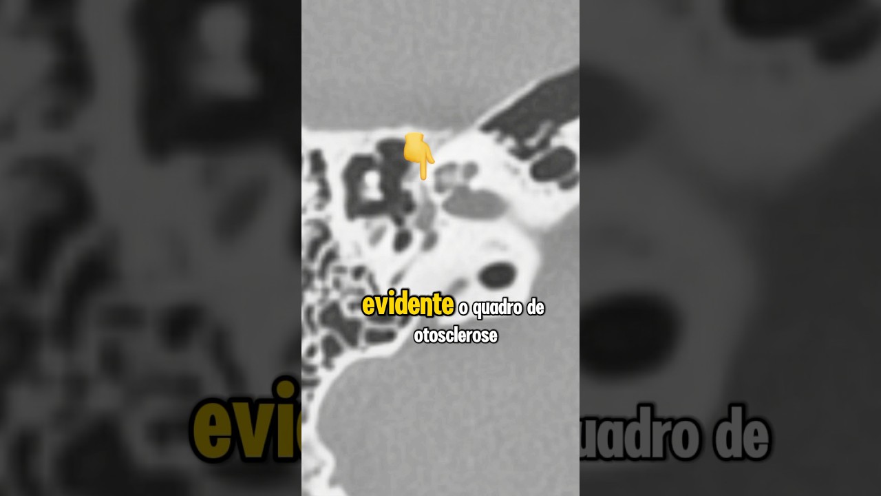 Diagn&oacute;stico ERRADO de OTOSCLEROSE #otosclerose #surdez #aparelhoauditivo #audi&ccedil;&atilde;o