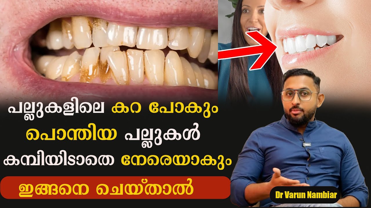 പല്ലുകളിലെ കറ പോകും പൊന്തിയ പല്ലുകൾ കമ്പിയിടാതെ താഴ്ന്നു ഷേപ്പ് ആകും ഇങ്ങനെ ചെയ്താൽ /#baijusvlogs