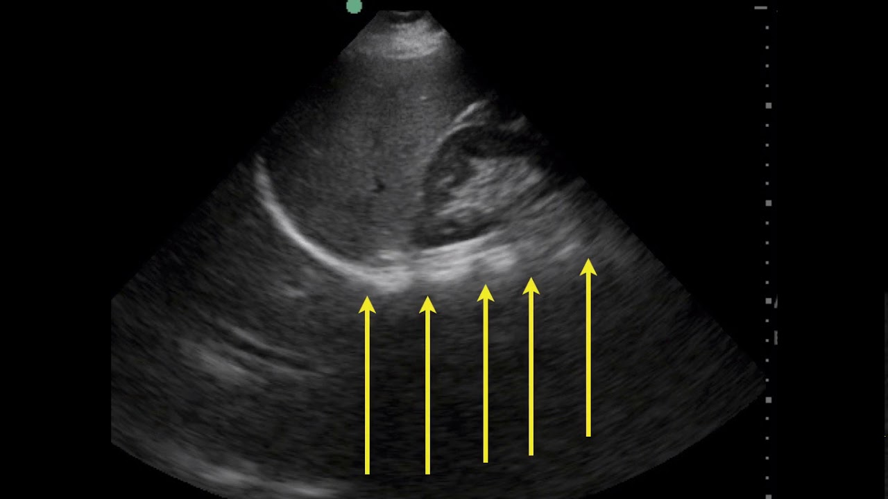 Pleural Effusion Ultrasound