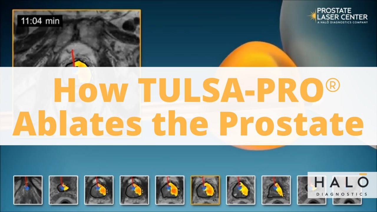 How TULSA-PRO (Trans-Urethral Ultrasound Ablation procedure) Works as a Prostate Cancer Treatment