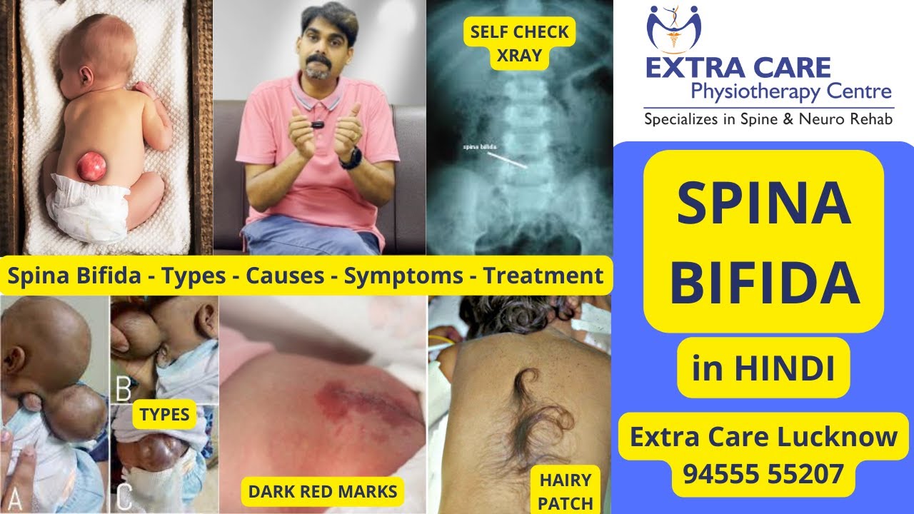 SPINA BIFIDA in Hindi | स्पाइना बिफिडा |  कारण, लक्षण व इलाज | Full Detailed Video | Extra Care