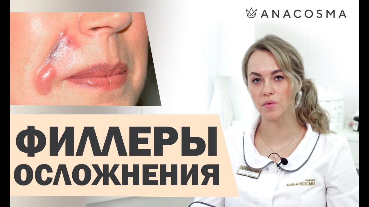 Филлеры в носогубные складки❗️❗️❗️ СТАРЯТ ЛИЦО❗️❗️❗️ ОСЛОЖНЕНИЯ❗️❗️❗️