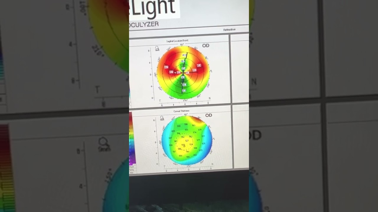 Pseudokeratoconus!  Multiple &ldquo;coincidences&rdquo; and unraveling this complex case: Kanellopoulos, MD