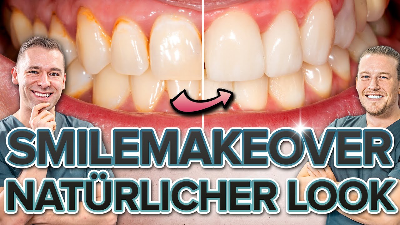 Smile Makeover - 8 Veneers in der Front | Frontzahnveneer Patientenfall