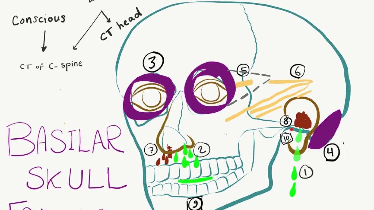 10 Signs and Symptoms Of Basilar Skull Fracture (Basal Skull Fracture)