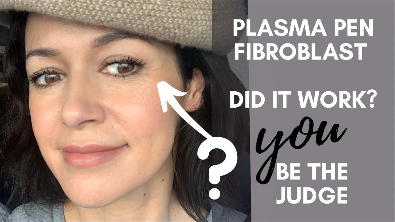 Fibroblast Plasma Pen - Does It Work? YOU decide. My 3 Month Before & After Pics & Videos