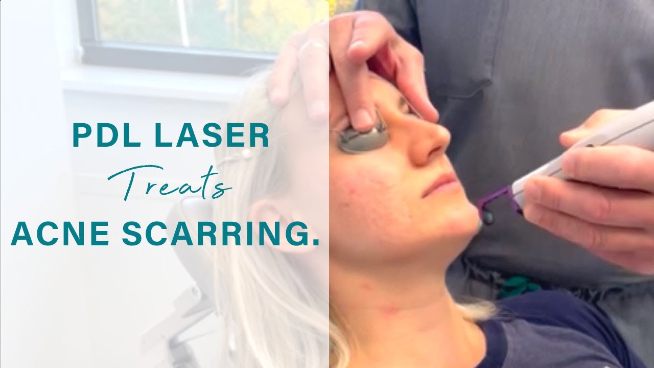 PDL Laser treats acne scarring | Board Certified Facial Plastic Surgeon