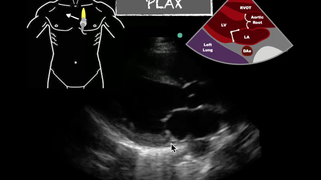POCUS   PLAX Severely Reduced EF