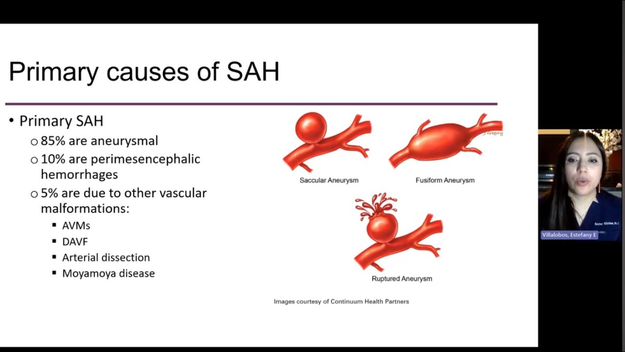Subarachnoid Hemorrhage