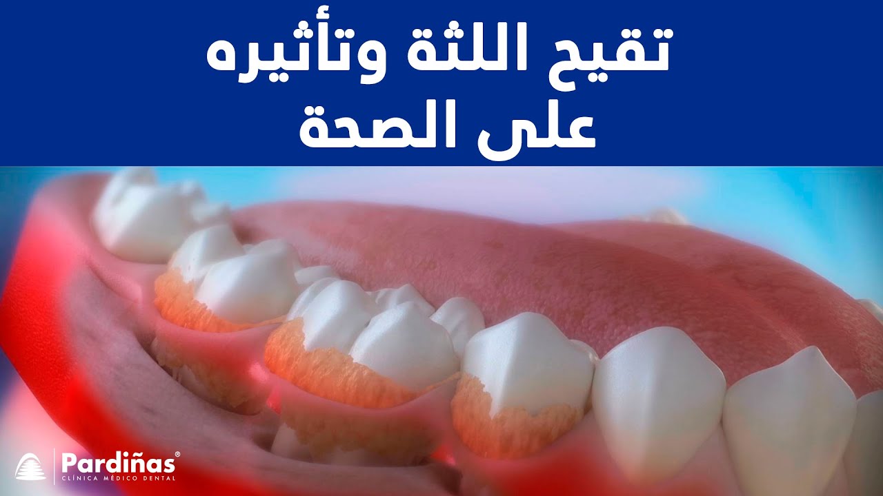 تقيح (اللثة) وتأثيره على الصحة ©