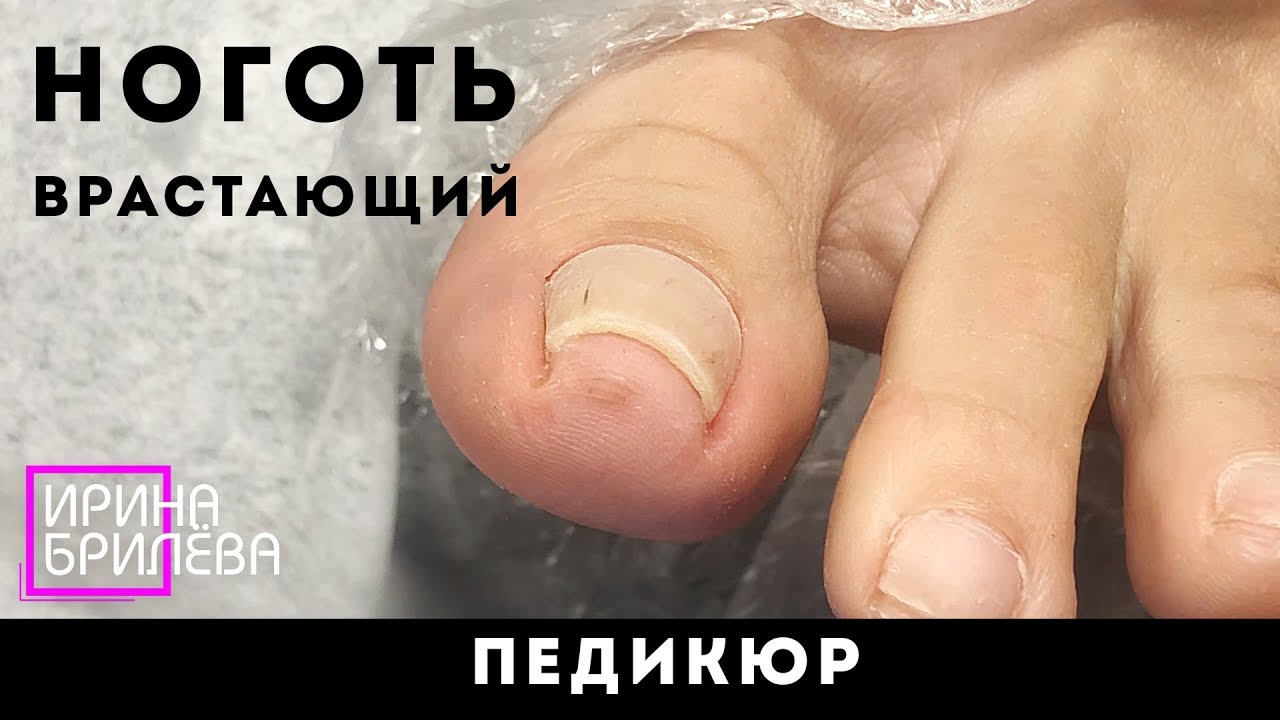 ПЕДИКЮР 🌸 Вросший ноготь / Ноготь, склонный к врастанию