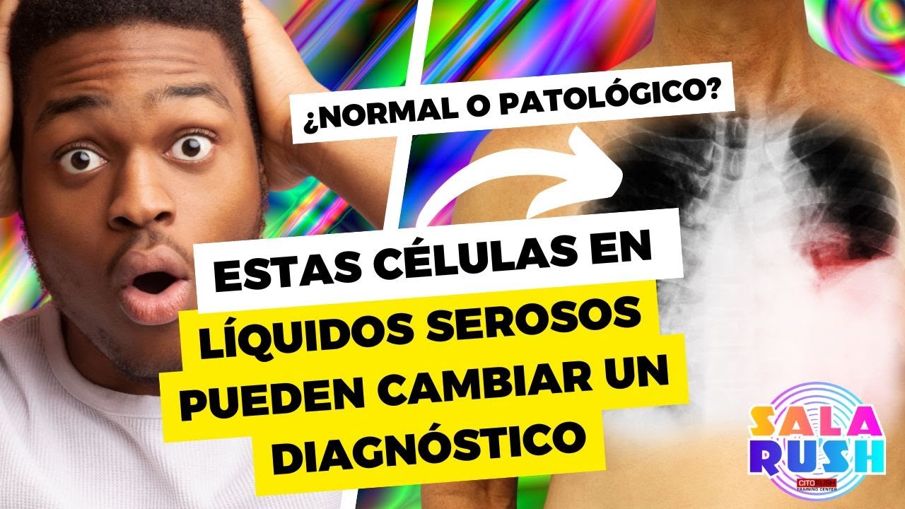 ¿Normal o Patológico? Estas Células en Líquidos Serosos Pueden Cambiar un Diagnóstico