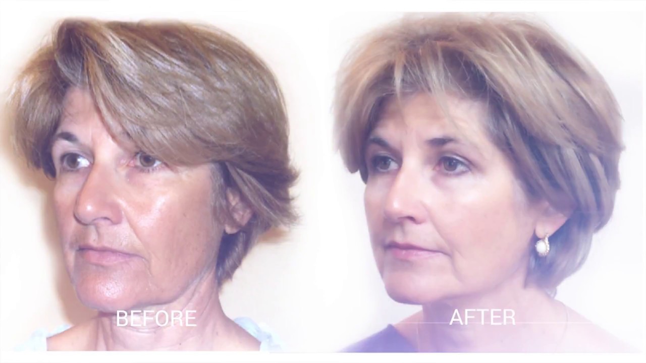 A Non-Surgical Facelift Alternative - Surgeon Minute