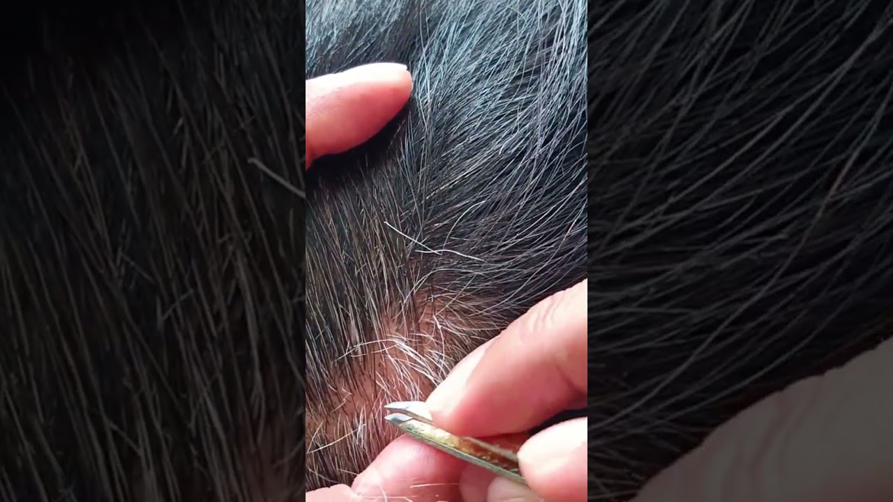 Most satisfying white hair removal #58#satisfying #hairremoval #satisfyingvideos 