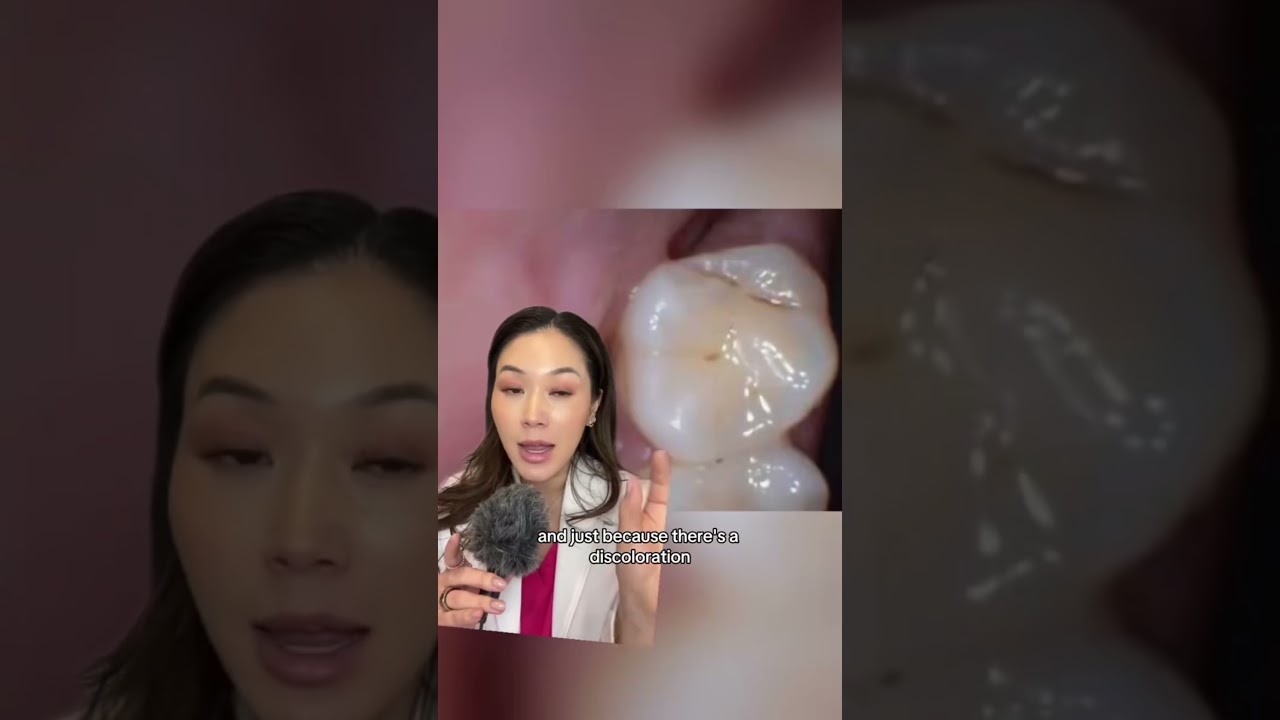 How to tell if you have a cavity. #cavity #cavities #dentist #selfexam