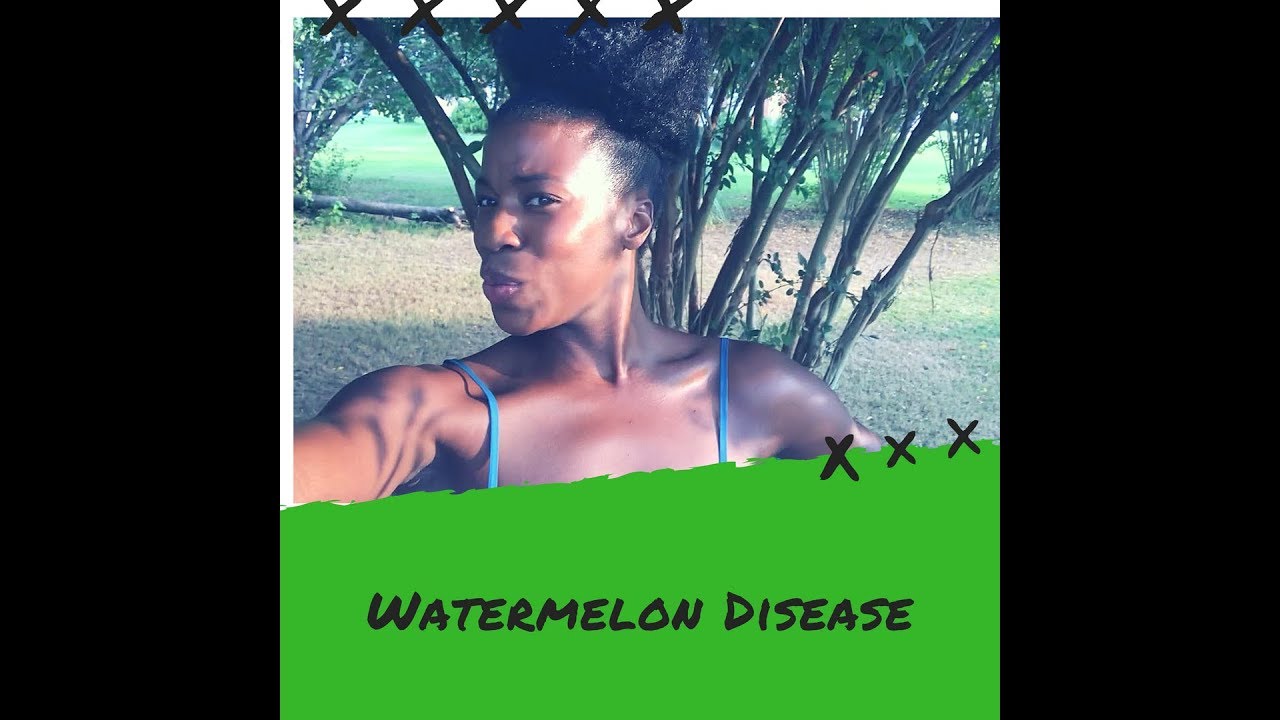 Season 1 Ep 4  The Watermelon Disease