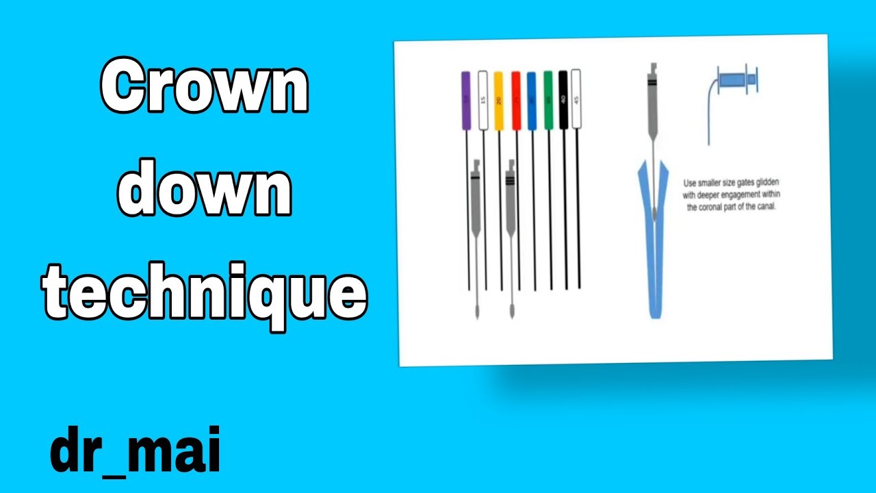 افضل شرح لل  Cleaning and shaping technique(Crown down manual instrumentation technique)