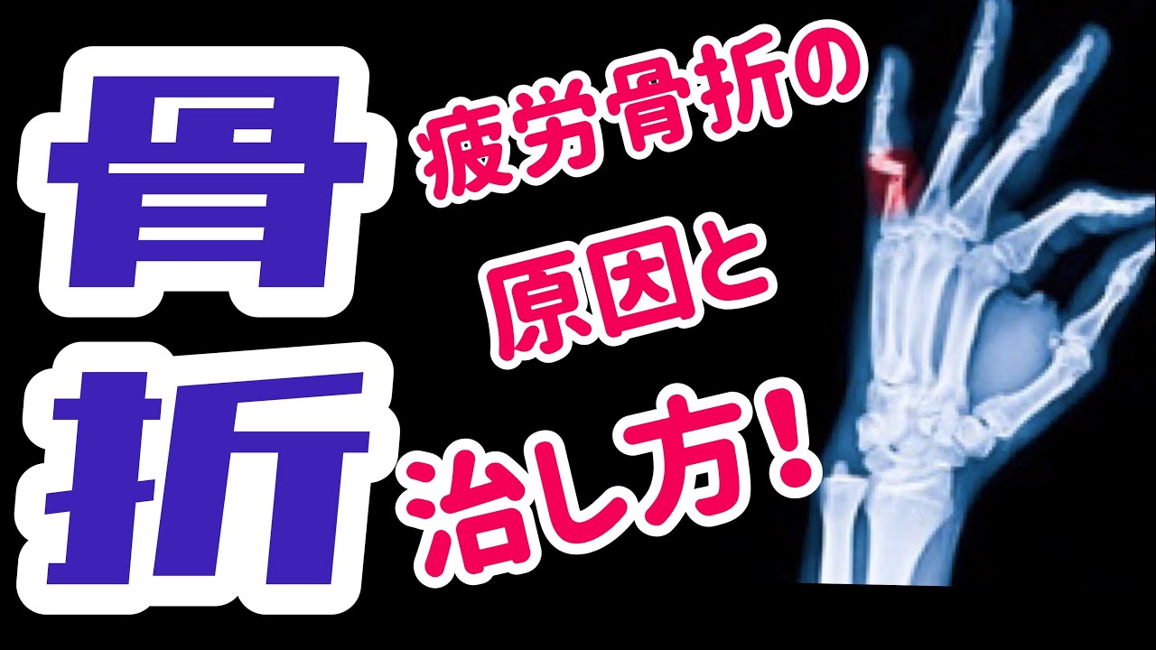 【骨折を早く治す方法】疲労骨折を早く治す！疲労骨折の原因と治し方！