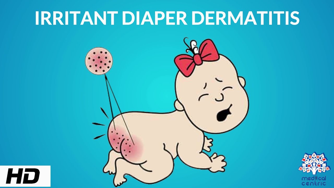 Irritant Diaper Dermatitis, Causes, Signs and Symptoms, Diagnosis and Treatment.