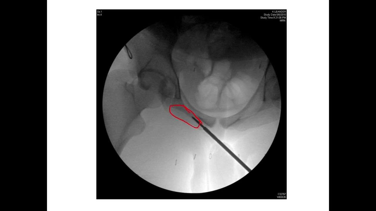 Percutaneous Acetabular Fixation