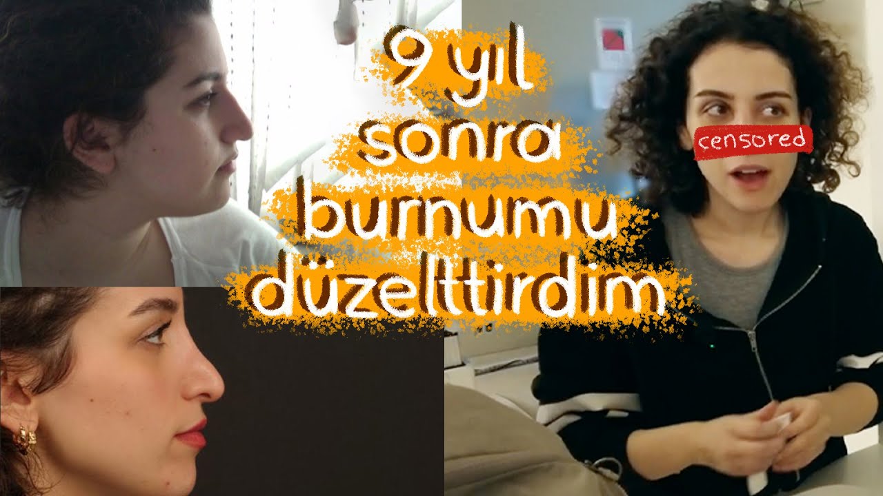 Revizyon Burun Ameliyatı Oldum | Ameliyat ve İlk 1 Hafta