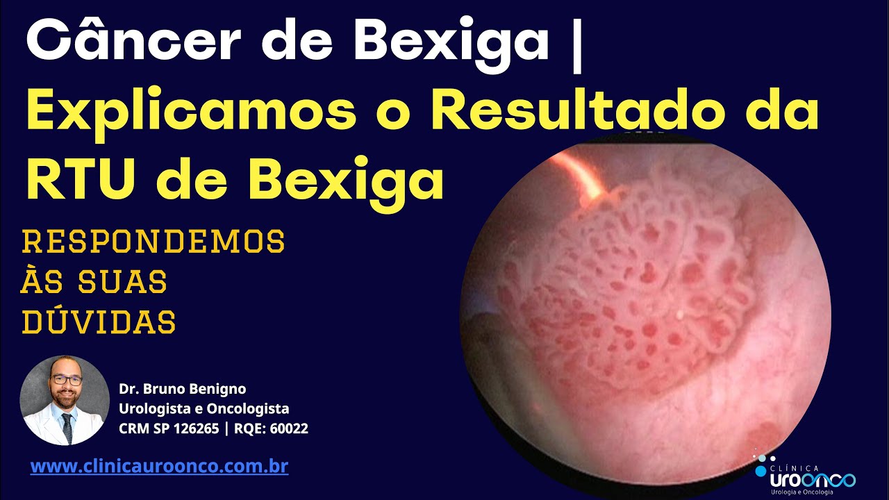 Bexiga | Entendendo  o resultado da raspagem para o diagnóstico do câncer e quando fazer BCG - Aula