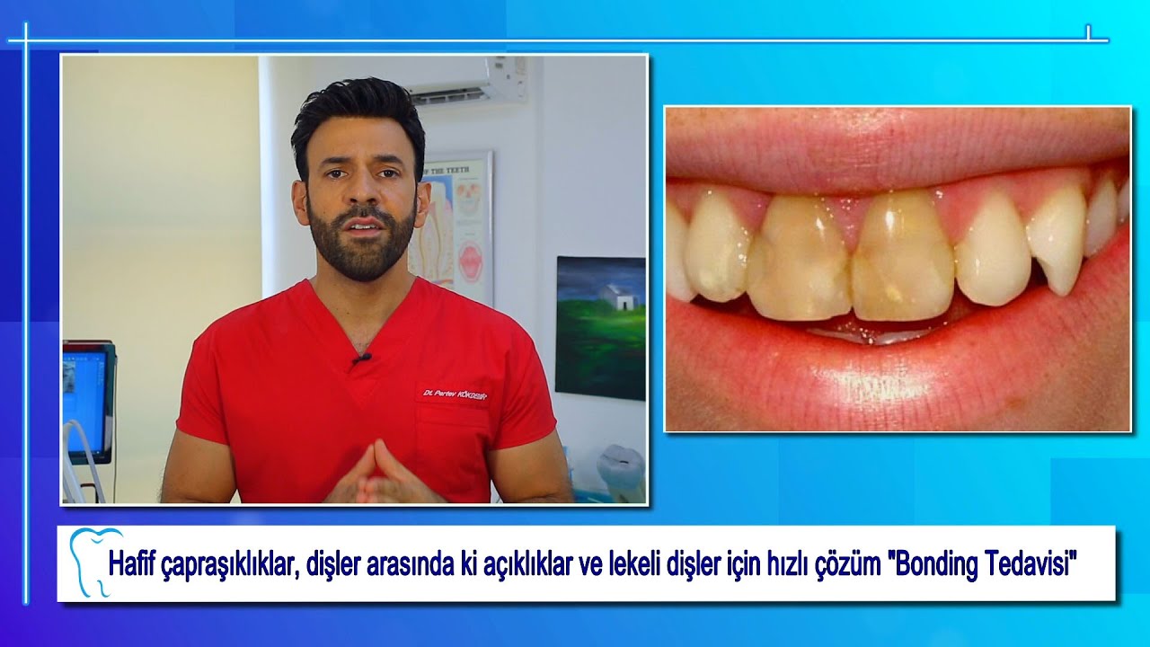 Bonding Tedavisi - Diş Hekimi Pertev Kökdemir İle 5 Dakika