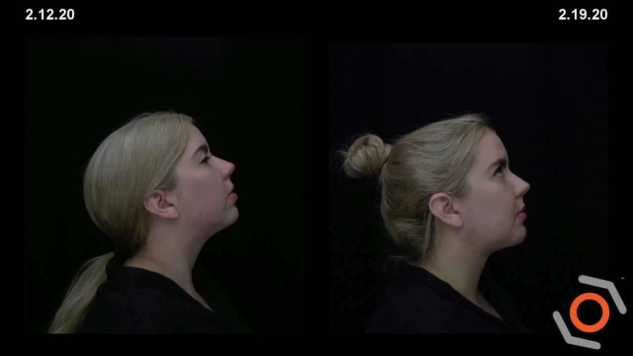 Before & After - MyEllevate&trade; Minimally Invasive Facial Rejuvenation Treatment