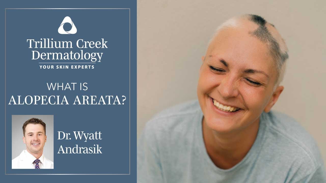 What is Alopecia Areata?