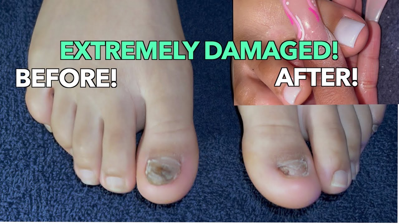 TOENAIL RECONSTRUCTION| ACRYLIC BIG TOENAIL| TOENAIL RIPPED OFF!