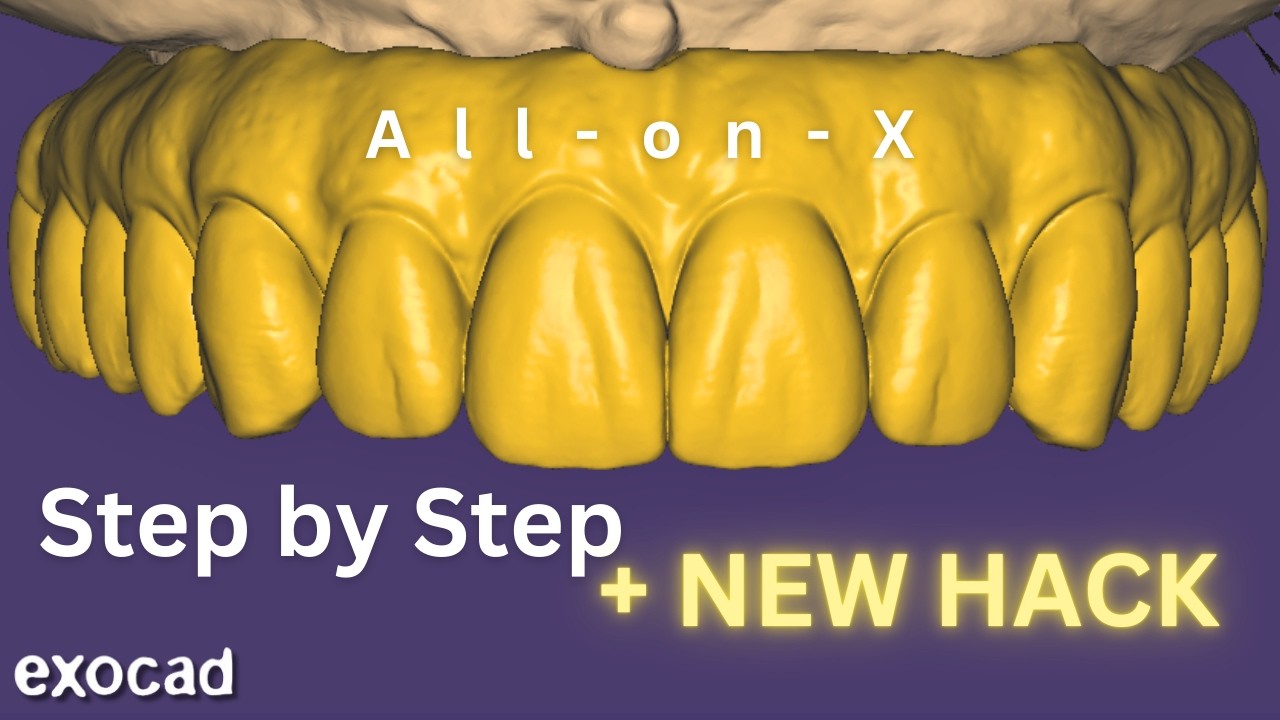 All-on-X 2025 EXOCAD 3.2 Tutorial (In Detail)