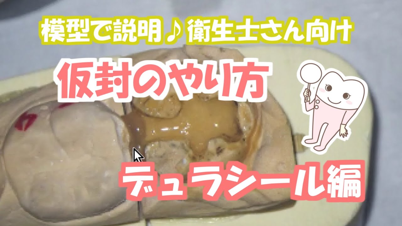 ⑤　【衛生士向け】インレー後の仮封のやり方