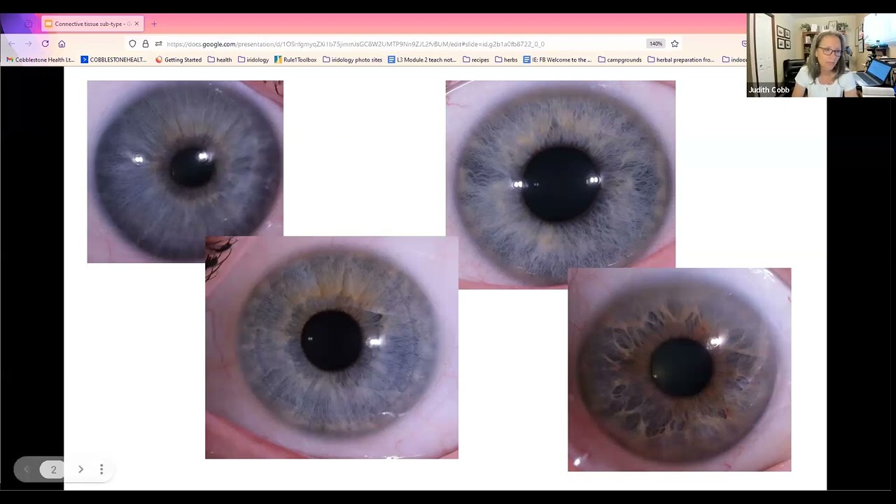 Iridology Subtype: Connective Tissue