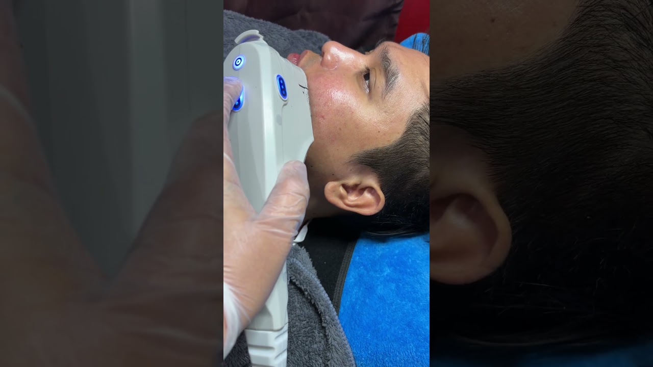 hifu vline face #hifutreatment #vlineface #mnichaesthetic