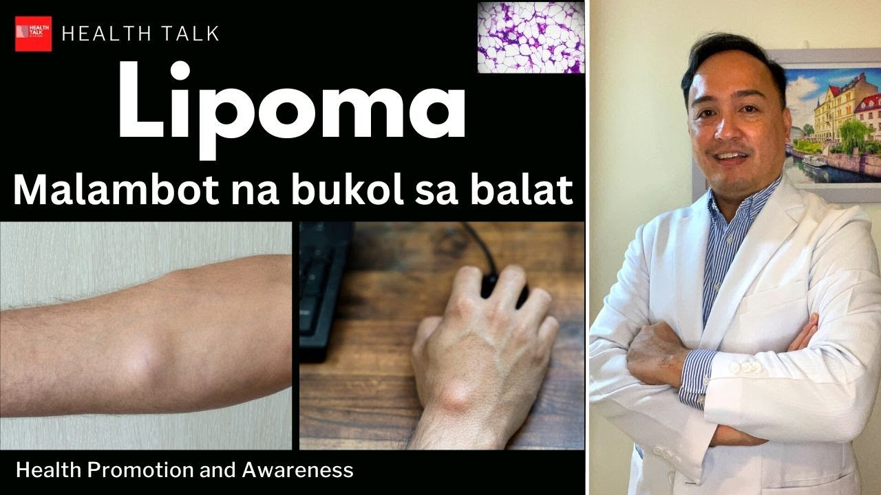 Lipoma: Malambot na bukol sa ilalim ng balat ano ang dapat gawin?