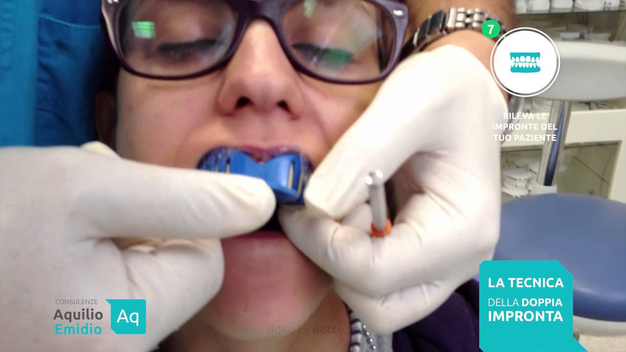 INVISALIGN - Tecnica della doppia impronta