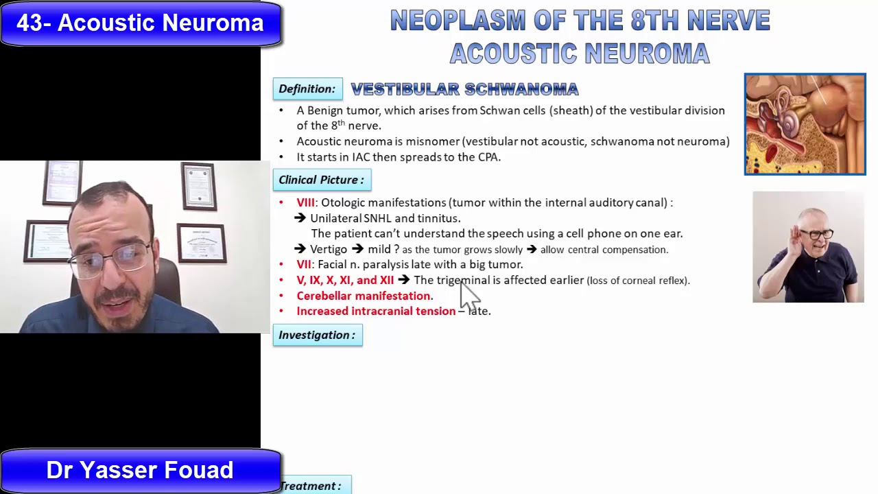43  Acoustic Neuroma