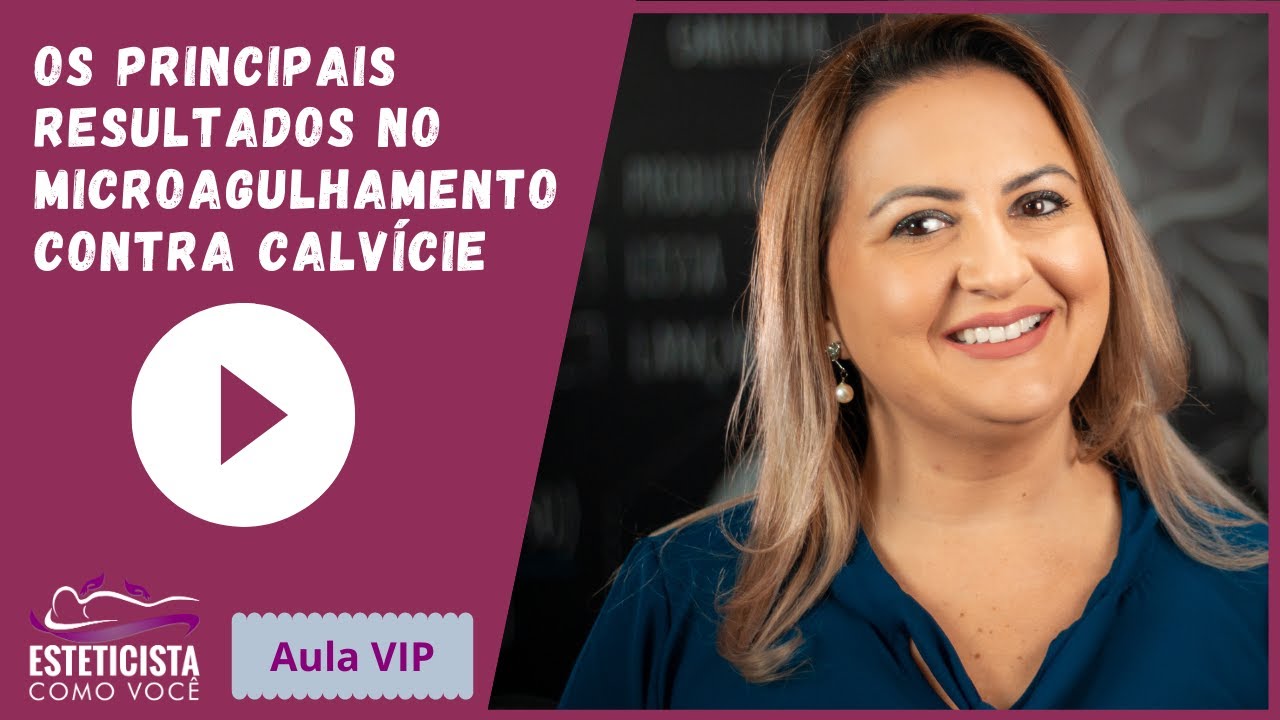 [Aula VIP] Os principais resultados no microagulhamento contra calvície