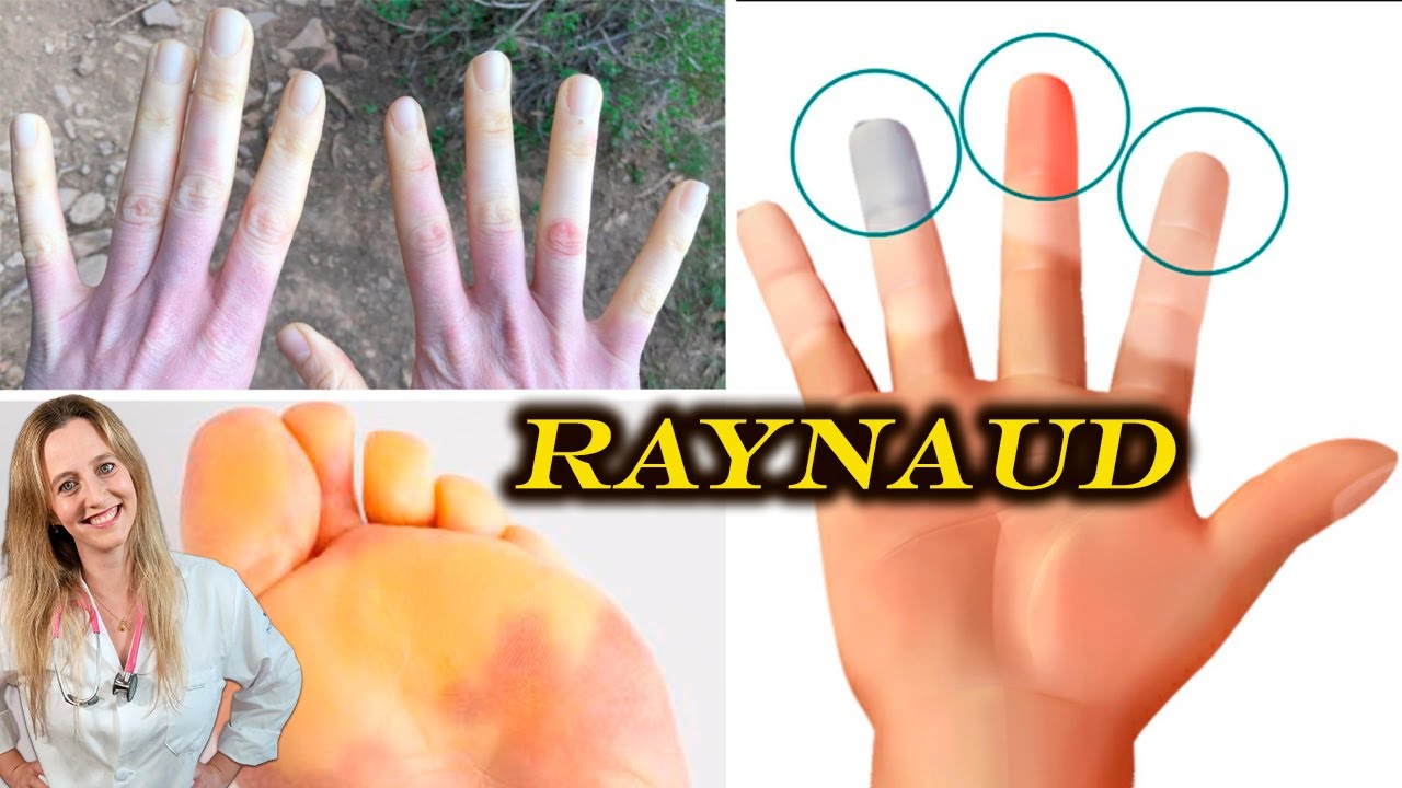 FENÓMENO DE RAYNAUD. SÍNTOMAS, TIPOS, DIAGNÓSTICO, TRATAMIENTO Y PREVENCIÓN - Dra Aperpin