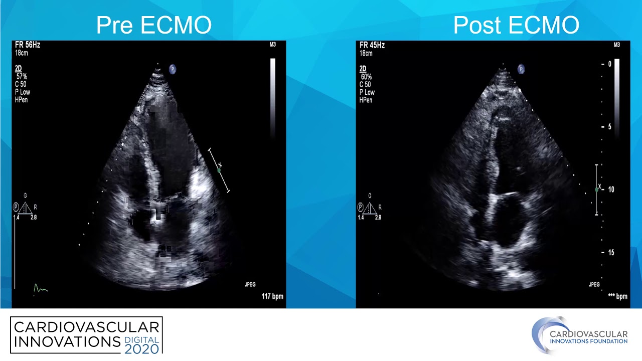3VD with new technical approach_A Garni_Coronary Case