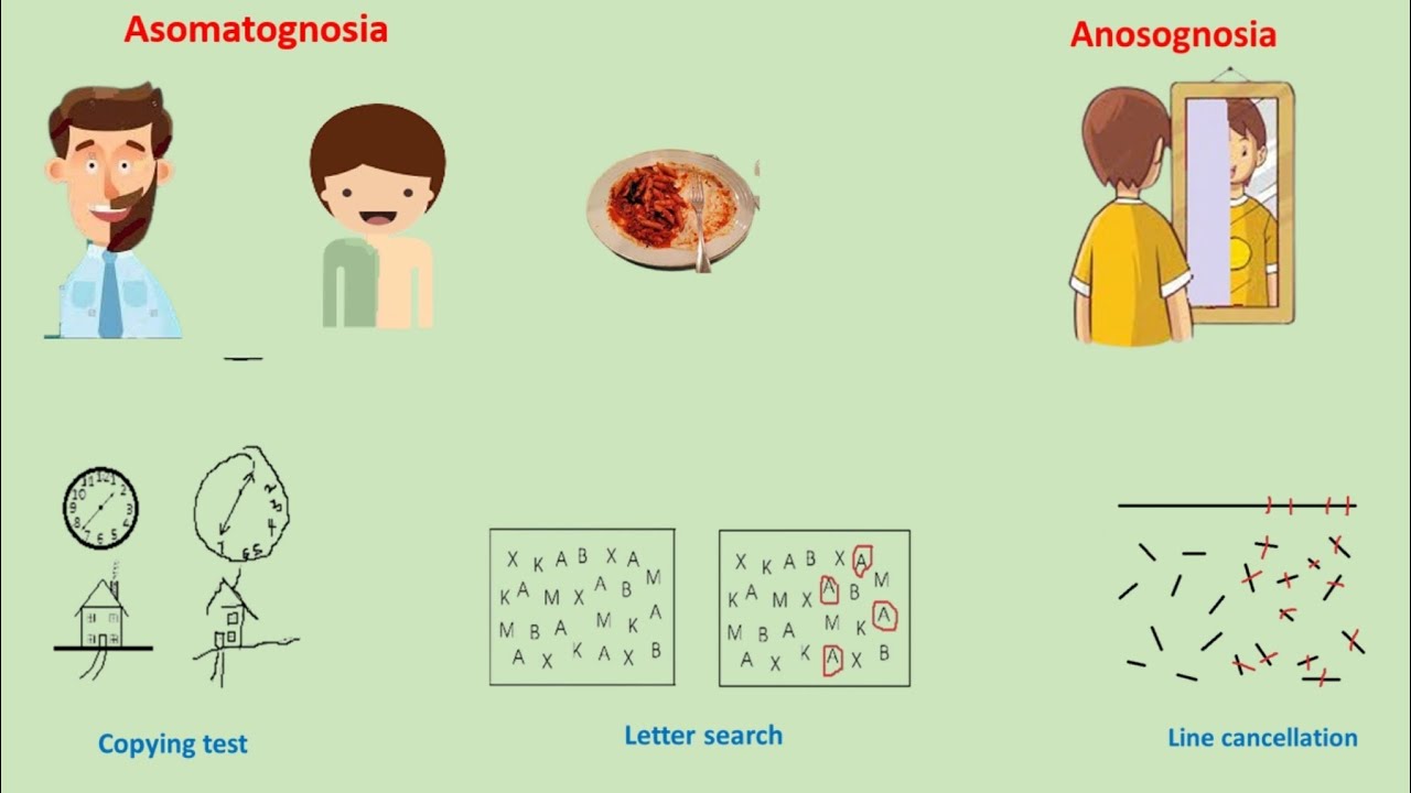 hemineglect syndrome | hemispatial neglect