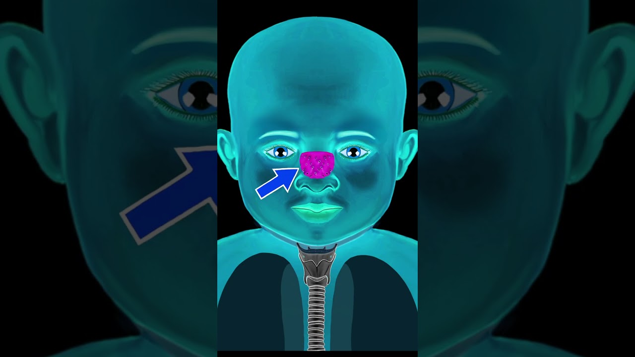 ADENOIDS #shorts