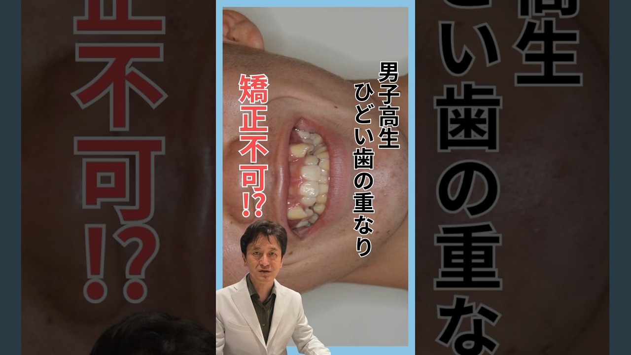 男子高生ひどい歯の重なり矯正不可⁉︎ #矯正歯科 #矯正 #男子高校生 #症例 #解説 #shorts