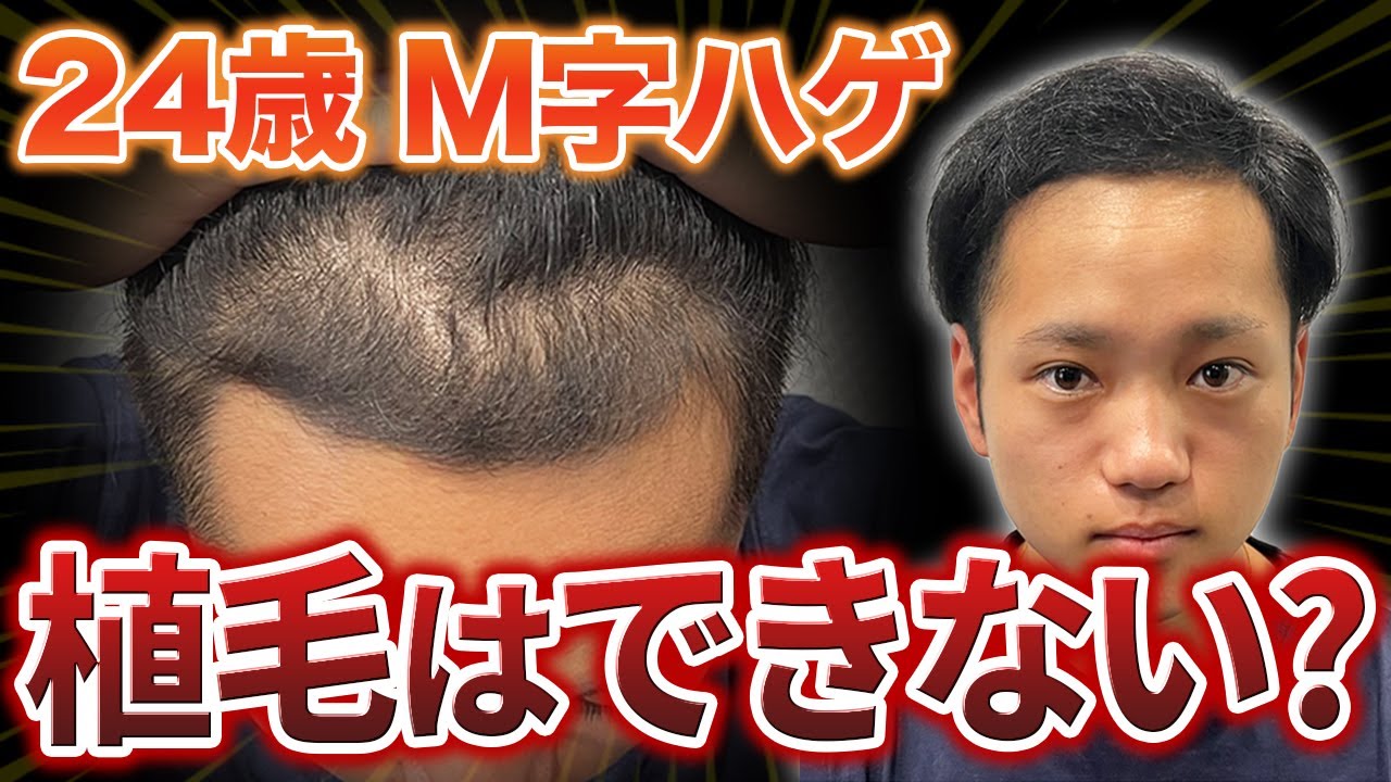 【M字ハゲ】20代の薄毛に悩む青年に植毛美容師が現実を伝えました。