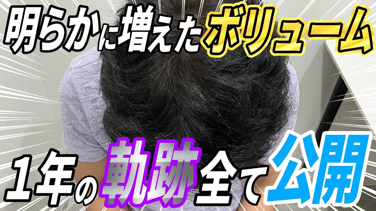 植毛手術1年後「理想と現実のギャップに戸惑う？」｜40代男性の生え際・前頭部1500株の1年経過