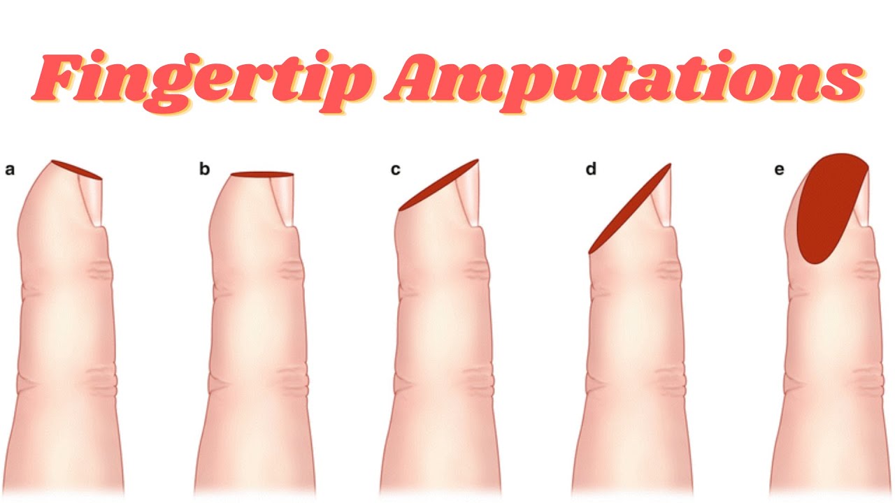 Fingertip Amputations And How To Treat Them