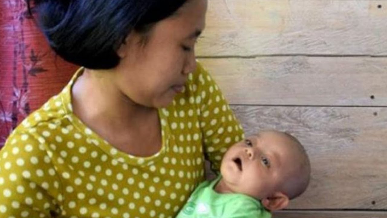 Kena Campak Rubella, Bayi 5 Bulan Ini Buta Dan Tuli