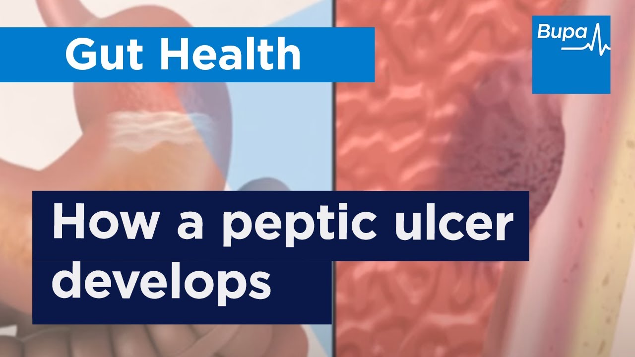 How a peptic ulcer develops | Bupa Health