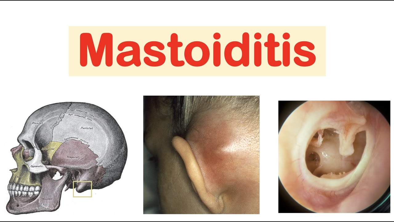 Mastoiditis (& Acute Otitis Media) | Causes, Pathophysiology, Symptoms, Diagnosis, Treatment